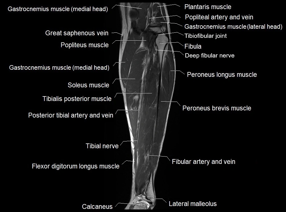 MRI 3T leg (tibia & fibula) labelled coronal cross sectional anatomy image 19.webp